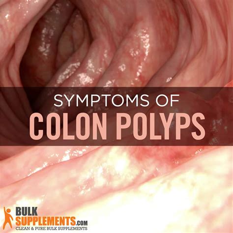 Colon Polyps Learn How To Prevent Them Now With Supplements