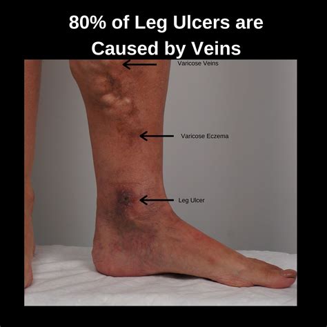 Common Complications Of Varicose Veins The Veincare Centre