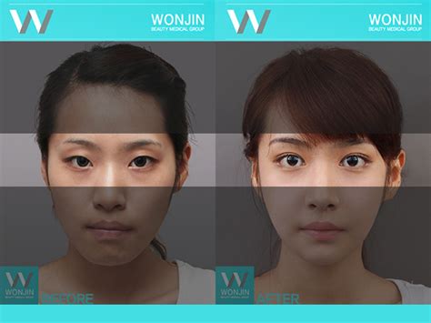 Get To Know Korean Eye Plastic Surgery Double Eyelid Surgery 짱이뻐