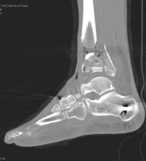 Fracture Distal Right Tibia And Fibula With Vascular Spasm Trauma