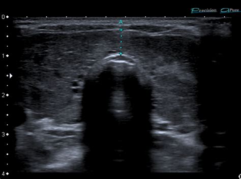 Ultrasound may be used for people who can't undergo a radioactive iodine uptake test. Graves disease | Image | Radiopaedia.org