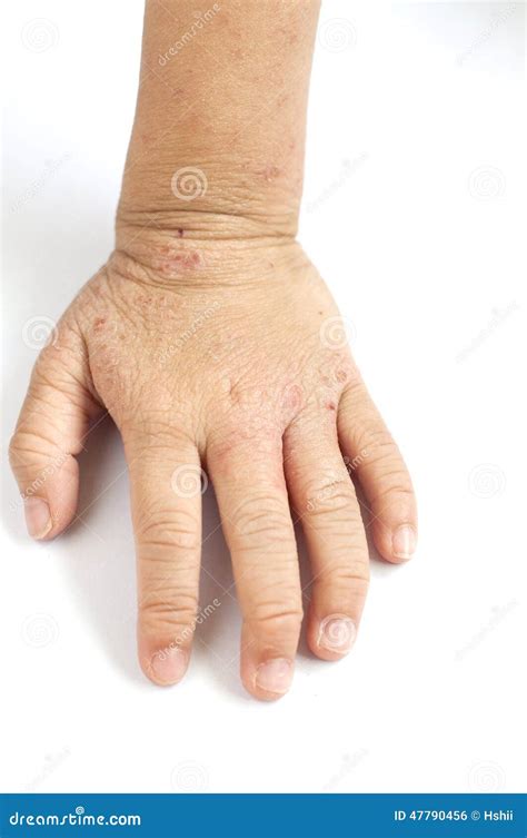 Eczema On Hand Stock Photo Image 47790456