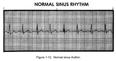 Figure 1 12 Normal Sinus Rhythm Cardiac Rhythm Interpretation