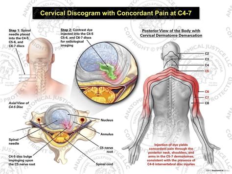 Male Left Cervical Discogram With Concordant Pain At C4 7