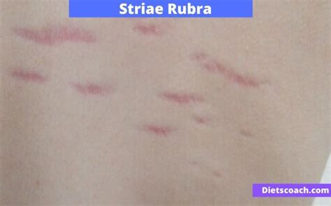 Types Of Stretch Marks With Pictures Striae Classification
