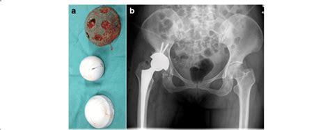 Hip Revision In The Foregoing Patient At 6 Months Postoperatively A