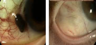 Prospective Study Of Sentinel Lymph Node Biopsy For Conjunctival