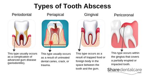 Periodontal Abscess Symptoms Causes And Treatment Share Dental Care