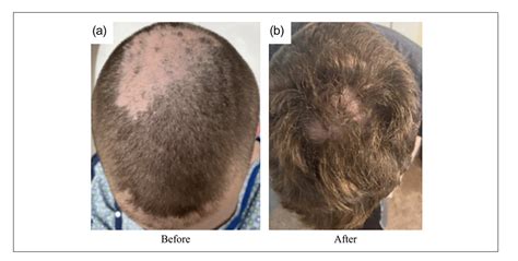 N Acetylcysteine Nac In Trichotillomania — Donovan Hair Clinic
