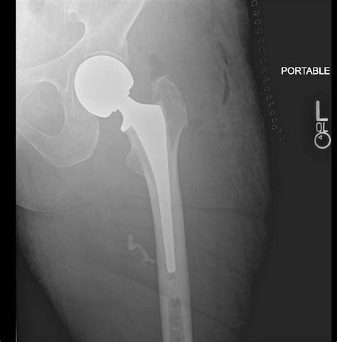 Repeat Ap Left Hip Radiograph Taken On The First Postoperative Day