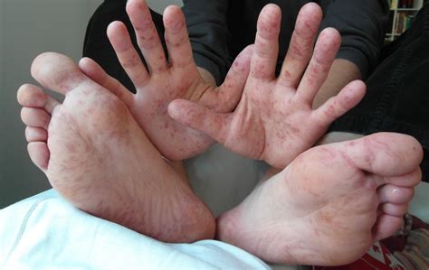 7 important facts about hand foot and mouth disease hfmd
