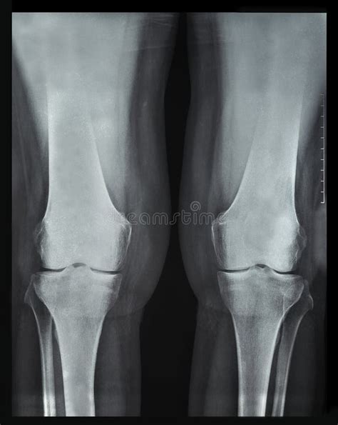 X Ray Rheumatic Diseases And Knee Rheumatoid Arthritis Stock Image