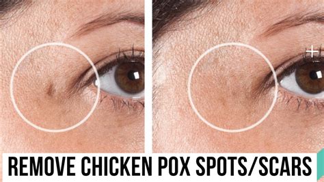 How To Remove Chicken Pox Spotsscars Naturally Works 100 By Natural