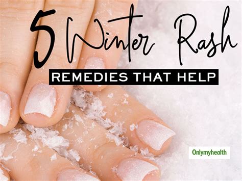 Winter Rash What Leads To Winter Rashes And Ways To Get Rid Of This