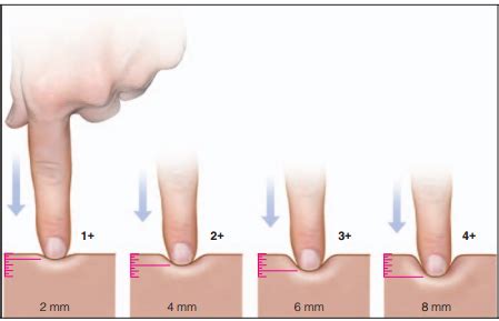 Scale For Pitting Edema