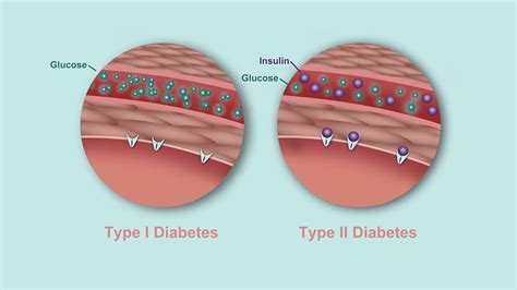 Whats The Difference Between Type 1 And Type 2 Diabetes Diabetes Center Christ Memorial