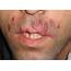 Full Text Chronic Perioral Tuberculosis Skin Lesions In A 21 Year Old 