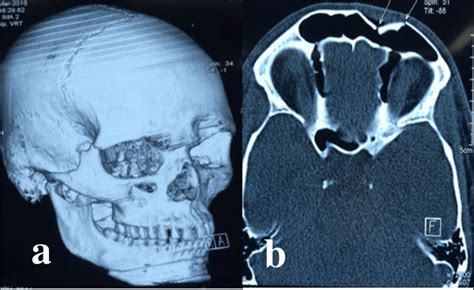 a and 3b: Depressed fracture Lt. Frontal bone and ...