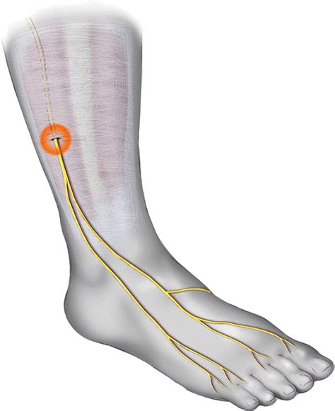 Peripheral Nerve Entrapments Foot And Ankle Clinics