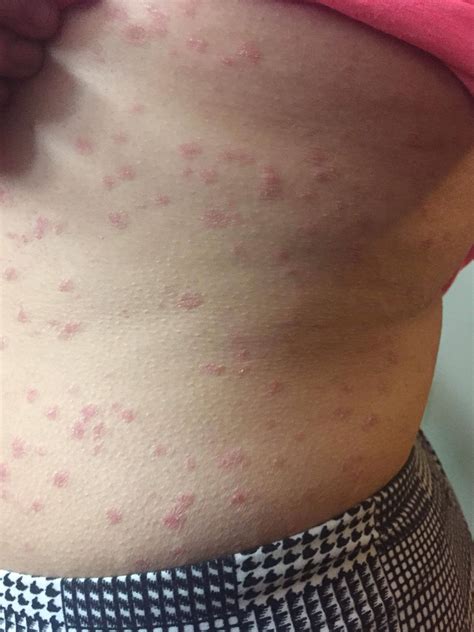A Painless Non Contagious Yet Rapid And Recurring Rash Any Ideas