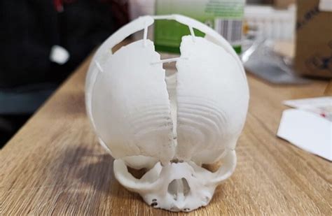Bebê Nasce Sem Parte Do Crânio E é Salva Por Prótese Feita Em Impressora 3d
