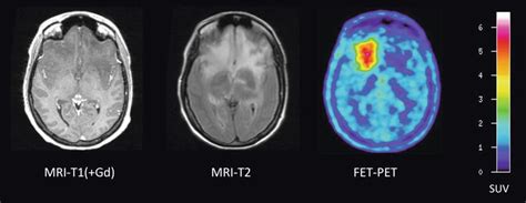 Imaging Of Brain Tumors Radiology Key