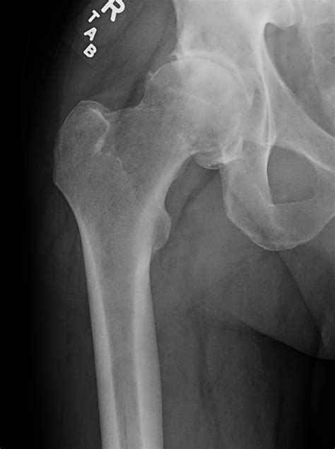 Outpatient Total Hip Replacement Seaside Surgery Center