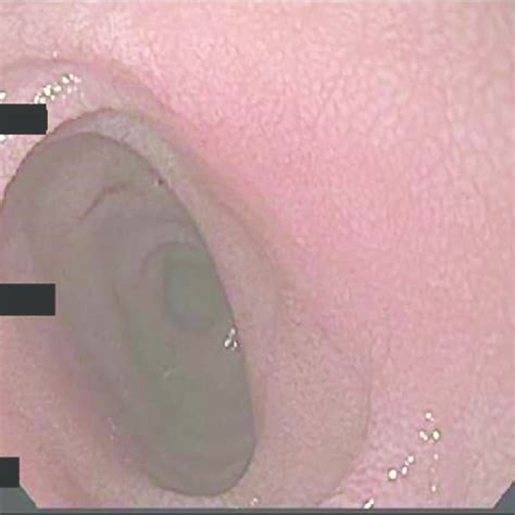 Endoscopic Photo Of The Patients Duodenum The Duodenal Mucosa Appears