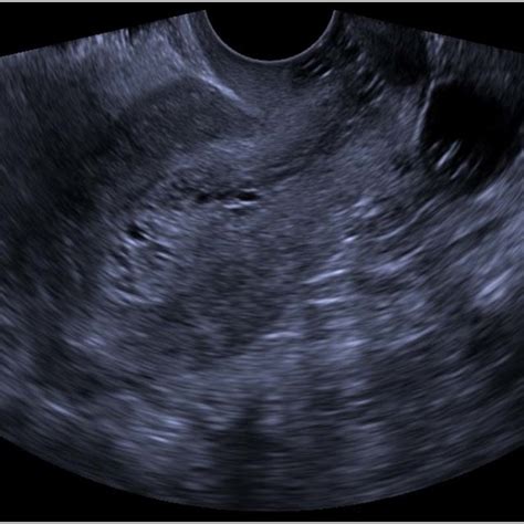 Pelvic Ultrasound Demonstrating A Thickened Heterogeneous Endometrial