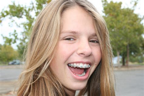 Top Tips For When You First Get Braces Manchester Orthodontics