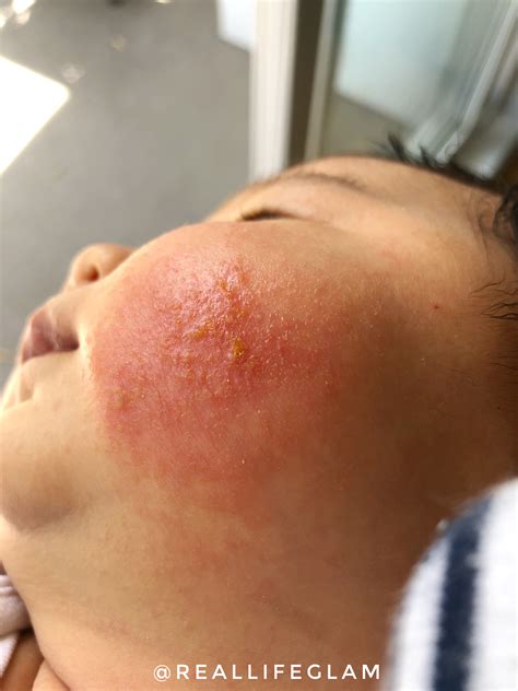Baby Eczema Skincare Routine