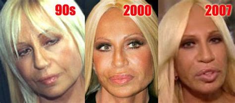Celebrity Plastic Surgery Before After Pics Donatella Versace