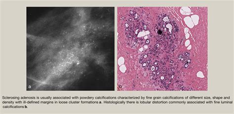 Benign Microcalcification And Its Differential Diagnosis In Breast