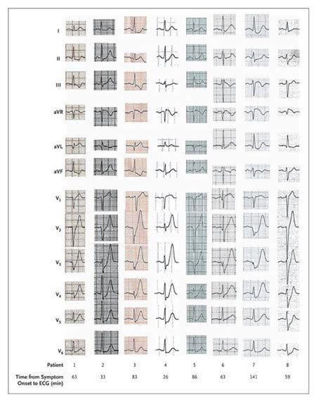 Patient:innen mit solchen ekgs und passender symptomatik brauchen potentiell dringend eine herzkatheteruntersuchung. ECG Rhythms: De Winter's ST/T ECG changes in huge anterior ...