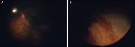 Fundus Photograph Of Left Eye Taken During Pars Plana Vitrectomy Note