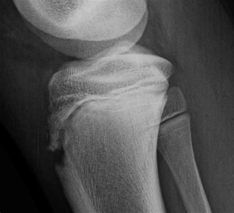 Tibial Tubercle Fractures The Bone School