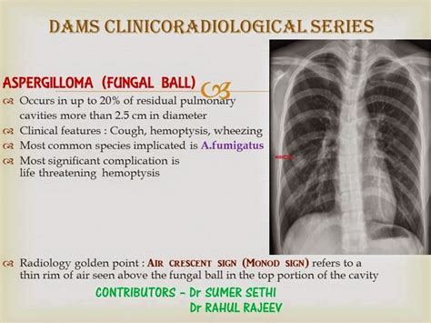 Aspergilloma Clinicoradiological Series Radiology Imaging