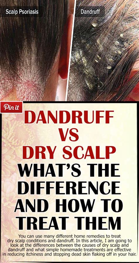 Dandruff Vs Dry Scalp Whats The Difference And How To Treat Them