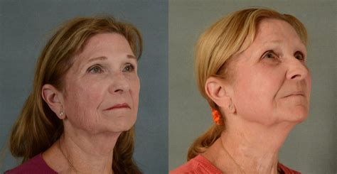 Physician Performed Chemical Peels Before And After Pictures Case 423 Tallahassee Fl