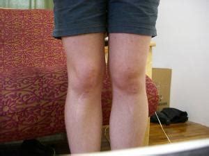 What causes water on the knee. Water on the knee treatment | General center ...