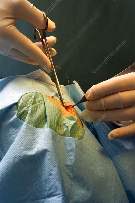 Skin Lesion Removal Stock Image M5510325 Science Photo Library