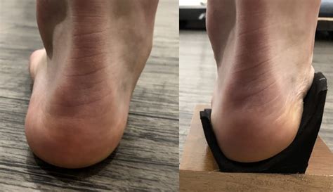 Tibialis Anterior Tendinopathy Ankle Foot And Orthotic Centre