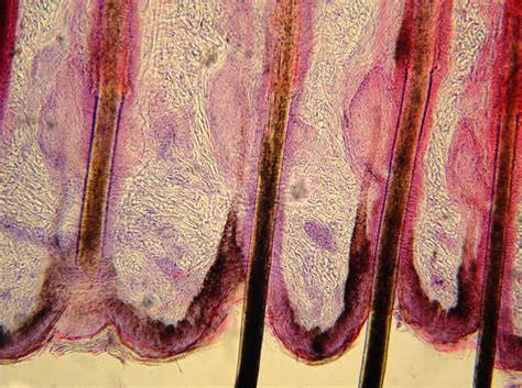 The existing hair falls out. Infected hair follicle | General center | SteadyHealth.com