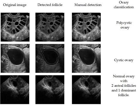 Follicle Detection And Ovarian Classification In Digital Ultrasound