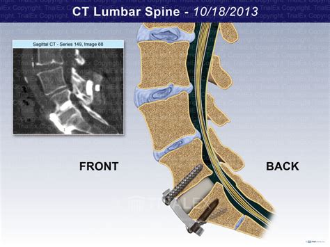 Ct Lumbar Spine Trialexhibits Inc