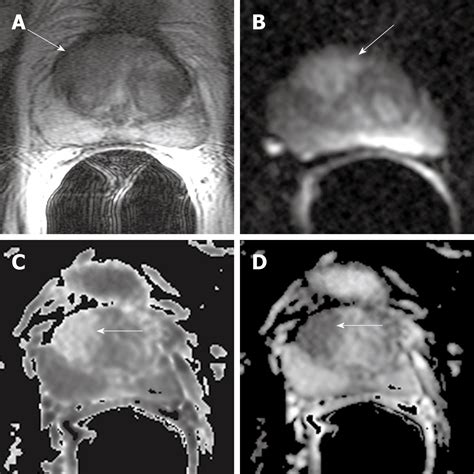 Incremental Value Of Magnetic Resonance Imaging In The Advanced Management Of Prostate Cancer