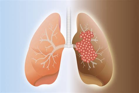 How Pah Can Develop In Advanced Lung Cancer Patients Seen In Study