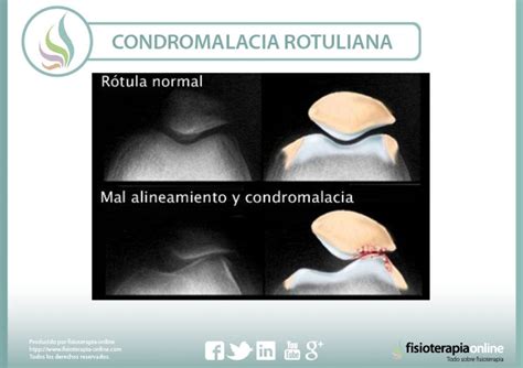 Condromalacia Rotuliana Qu Es Causas S Ntomas Tratamiento Y