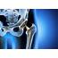 Hip Replacement Implant Loosening Symptoms