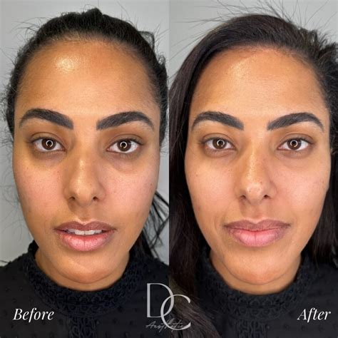 Will Tear Trough Filler Work For Me Dc Aesthetics Injectables And Skin